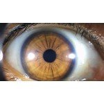 Irismacro HD - série USB720P2015 - iridoscopio iridologia, irisdiagnose.
